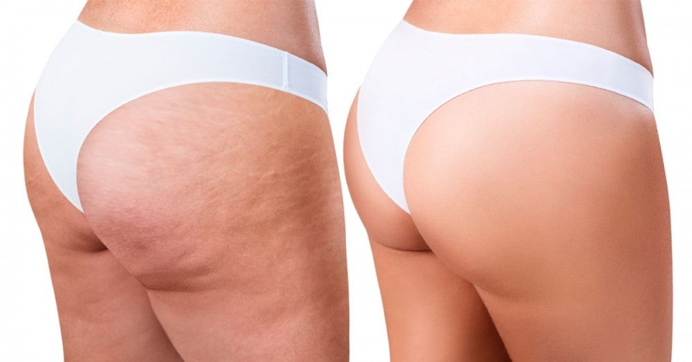 Антицелулитен уред - Celluless MD
