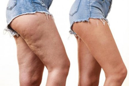 Антицелулитен уред - Celluless MD